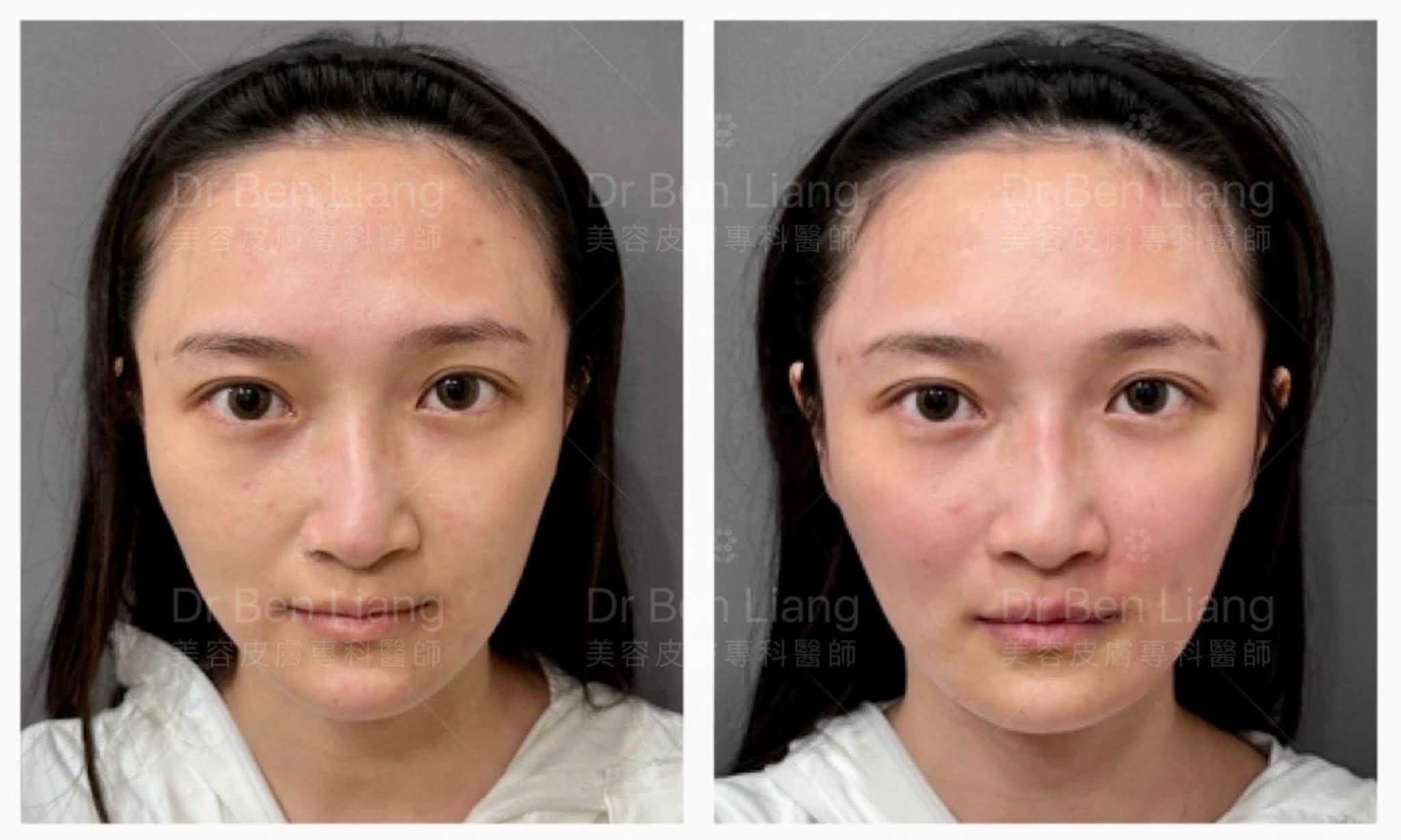 手把手尖針班術前術後正面案例對照